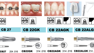 D+Z小編帶你了解摘除牙套后續